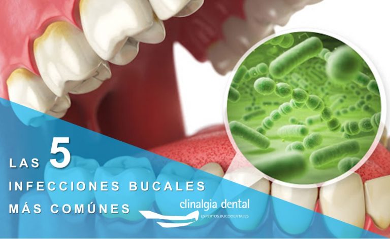 Infecciones Bucales Más Comunes 2576