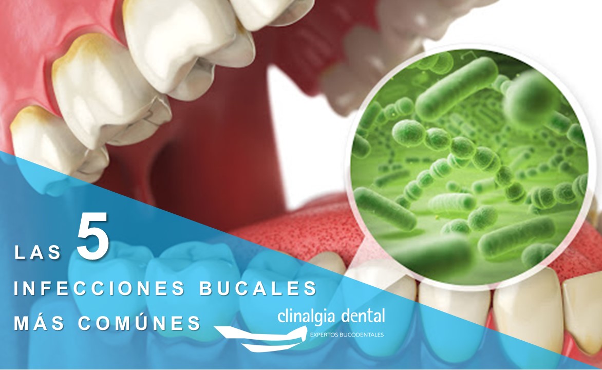 infecciones bucales más comunes